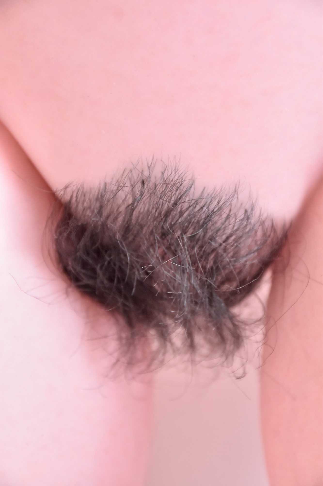 9-Hair or pubic hair implant（6）.jpg