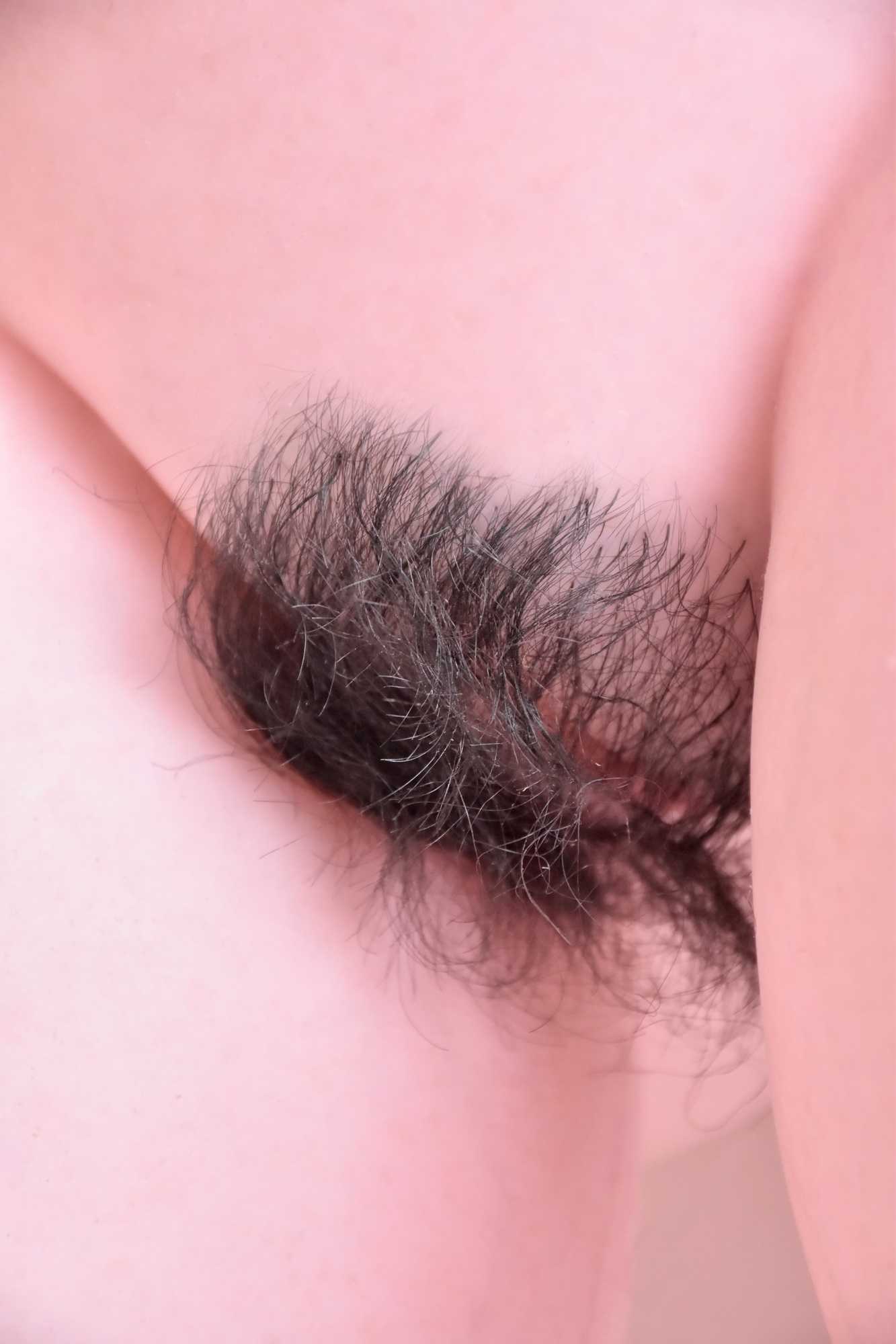 9-Hair or pubic hair implant（9）.jpg